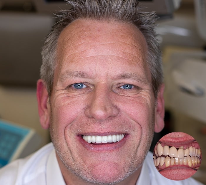 After having Dental Implants treatment