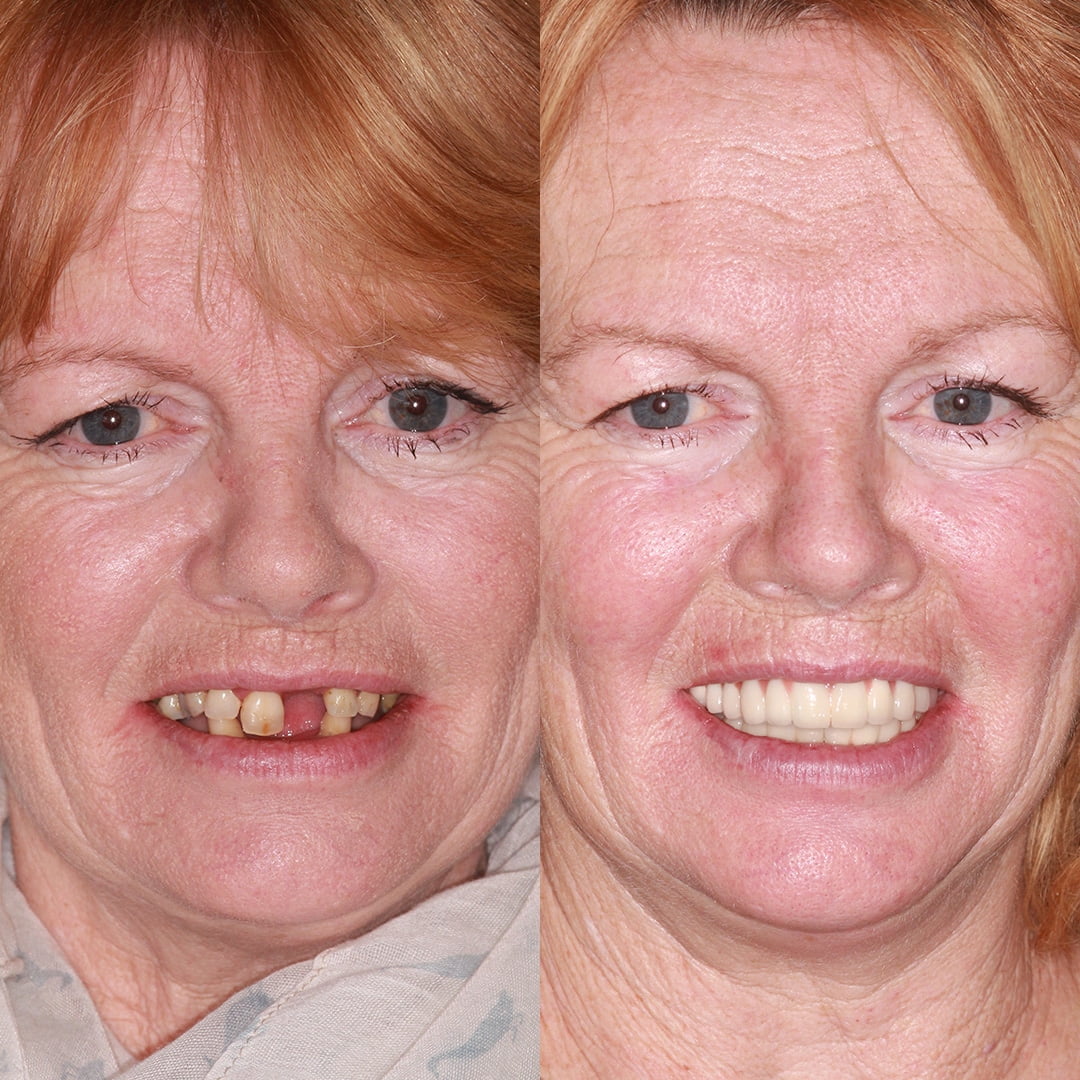 Full Mouth Dental Implants