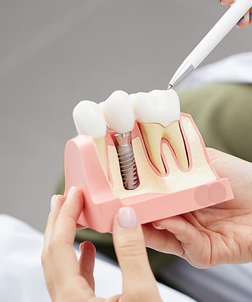 dental implants Glasgow