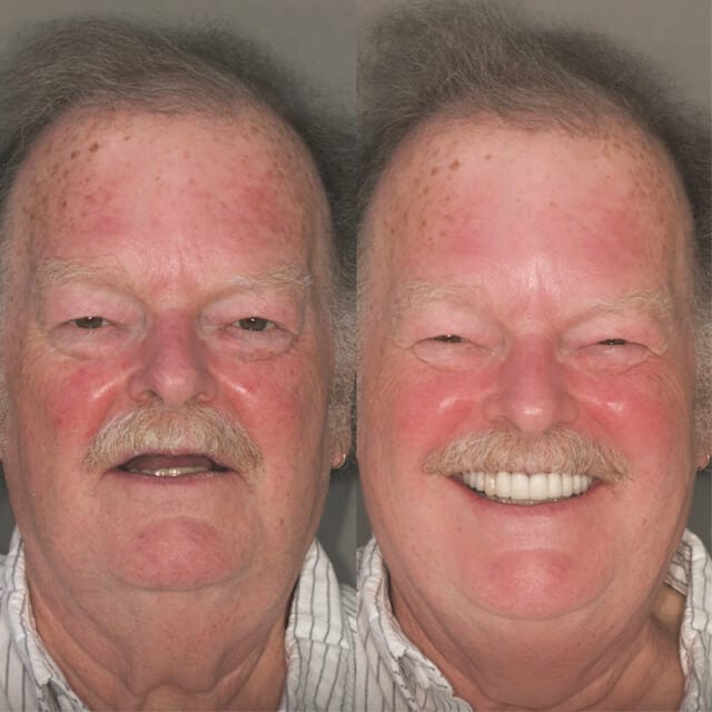 all on 4 dental implants Glasgow